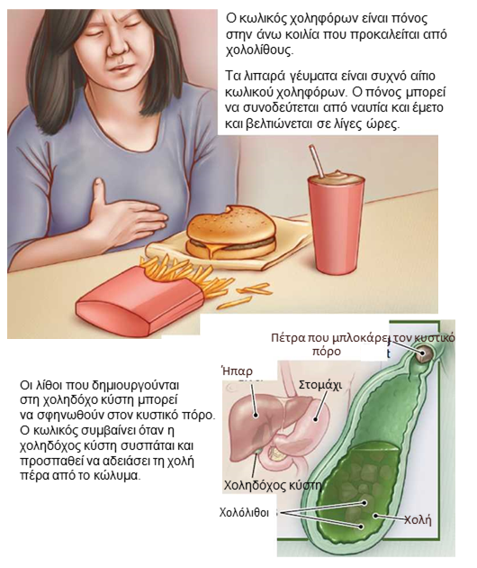 Gallstones1