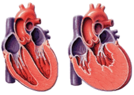 Υπερτασική καρδιοπάθεια