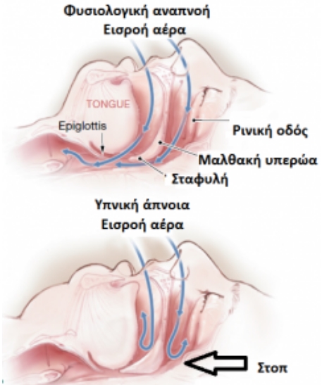 Υπνική άπνοια ως αιτία ανεξήγητης κόπωσης και υπέρτασης